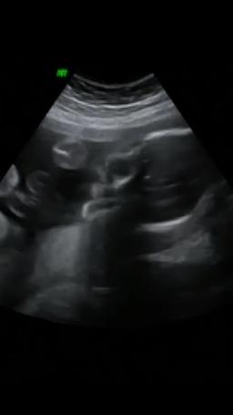 Darah Sama, Takdir Berbeda episode 1